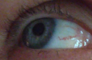 Woman’s Eyeball Blood Vessell Spells “Love”