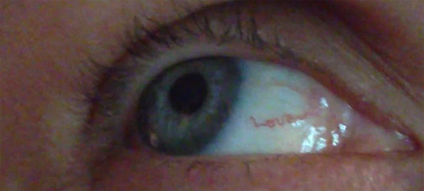 Woman’s Eyeball Blood Vessell Spells “Love”