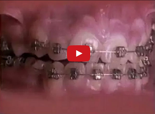 A Time-lapse Showing Braces Straightening Out Teeth