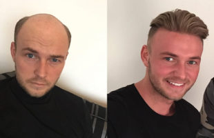 Finally! A Super Realistic Looking Glue-On Waterproof Toupee