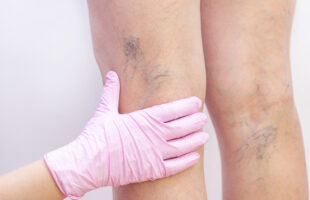 The Best Varicose Vein Treatments in Dallas, TX