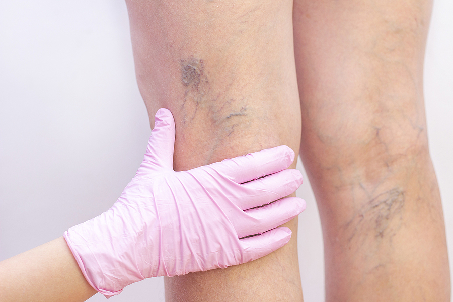 The Best Varicose Vein Treatments in Dallas, TX v