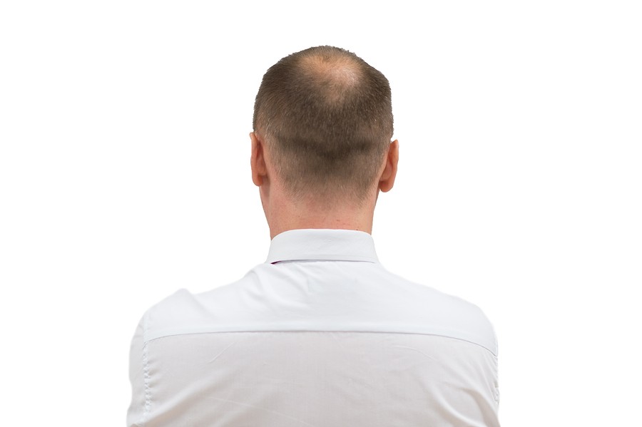 Human Alopecia Or Hair Loss – Adult Men Bald Head. Back Of Baldi