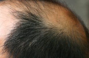 Male pattern hair loss – causes, symptoms and treatment 