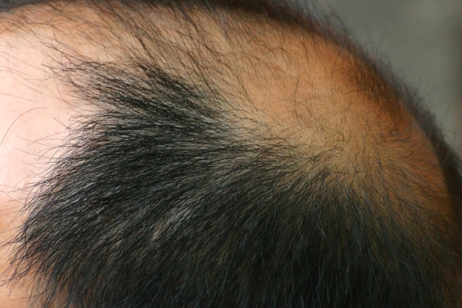 Male pattern hair loss - causes, symptoms and treatment Bald Pate