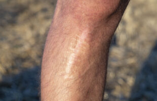Will Self Tanner Cover Scars?