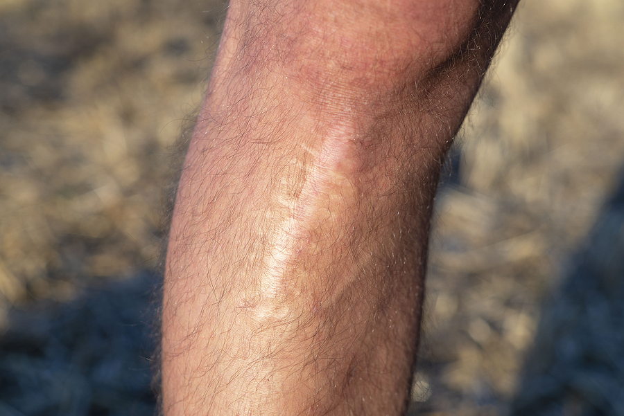 Will Self Tanner Cover Scars?