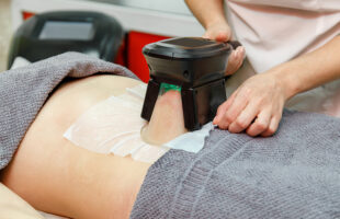 Best Areas to Tone With Coolsculpting