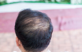 Stem Cell Hair Transplant: The Future of Non-Invasive Hair Restoration