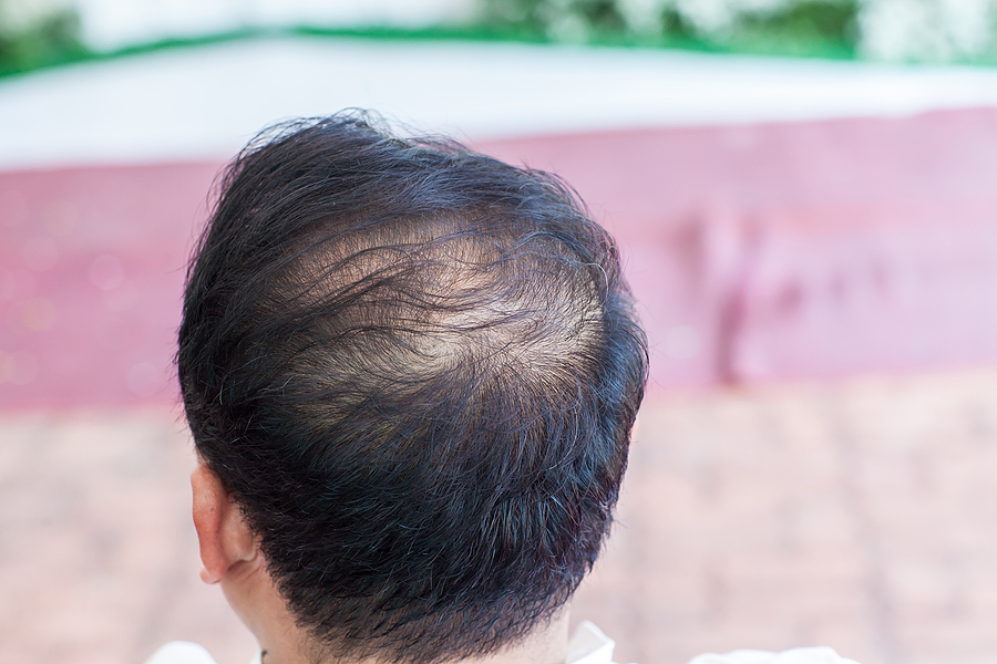 Close Up Hair Loss, Thinning Hair And Scalp Issue. Hair Loss Tre