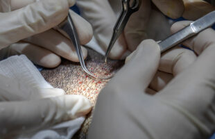 Where Is The Best Place To Get A Hair Transplant?
