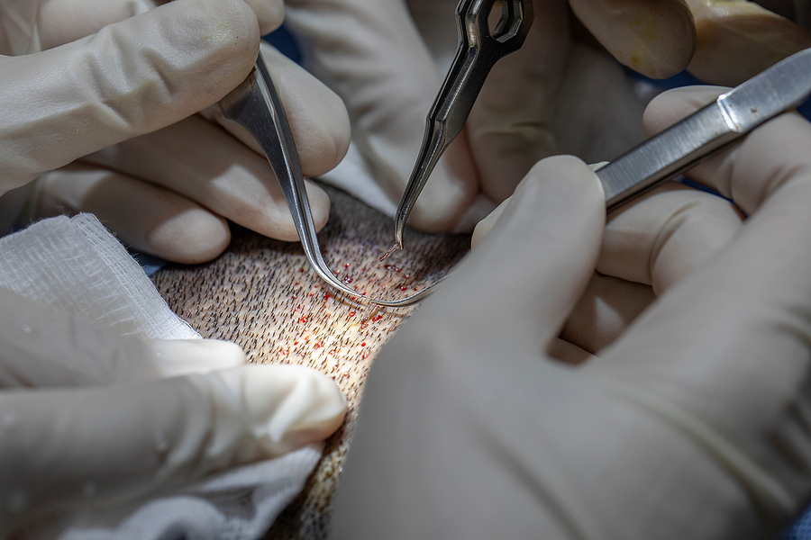 Where Is The Best Place To Get A Hair Transplant? Hair Transplantation Process, Pulling Hair Follicles Back And Re