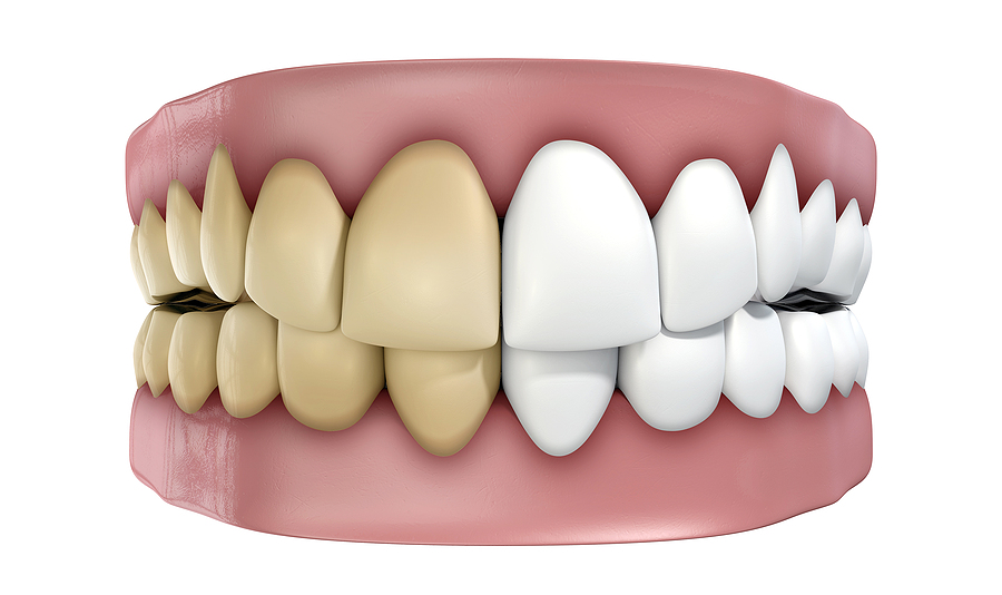 Your All-Time Favourite Drinks Are Damaging Your White Teeth Teeth Set Isolated
