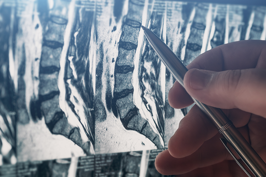 Dr. Thomas Frimpong Explains What Patients Need to Know About Spinal Surgery in 2021 Doctor Examines Mri Of Lumbar Spine With Pinched Discs Of Spine
