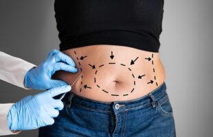  7 Reasons To Get The Liposuction For Reducing Body Fat