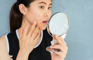 A Potential Treatment for Acne