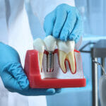 What are the Most Common Complications of Dental Implants?