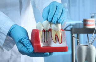 What are the Most Common Complications of Dental Implants?