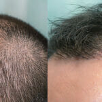 DHI Hair Transplant in Turkey: Things You Need to Know. Close up top view of a man's head with hair transplant surgery with a receding hair line. - 1-5 months after Bald head of hair loss treatment.