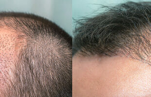 DHI Hair Transplant in Turkey: Things You Need to Know.