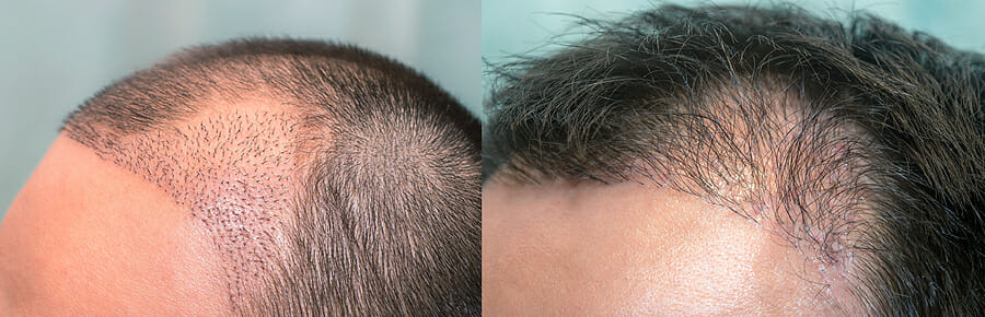 DHI Hair Transplant in Turkey: Things You Need to Know.