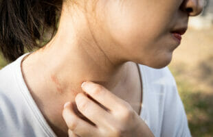 11 + Best Essential Oils for Itchy Skin | How to use & Safety