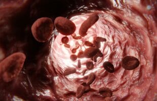 5 Ways to Prevent Broken Capillaries