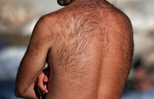 Say Goodbye to Back Hair: How Laser Hair Removal Can Help Men