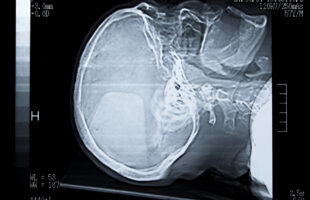 Eggshell Skull Rule: What Is It and How Is It Applied in Personal Injury Claims?