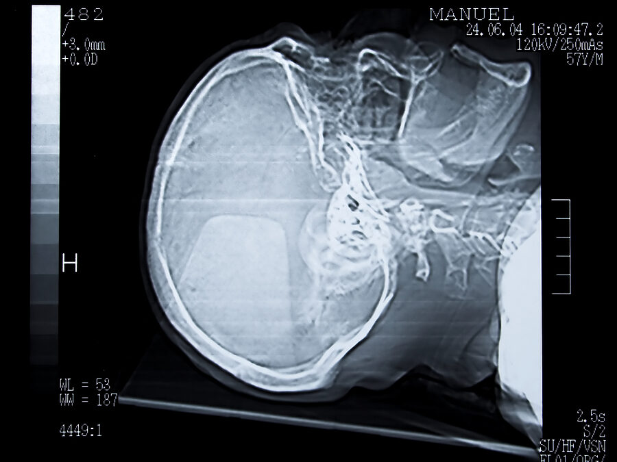 Eggshell Skull Rule: What Is It and How Is It Applied in Personal Injury Claims?