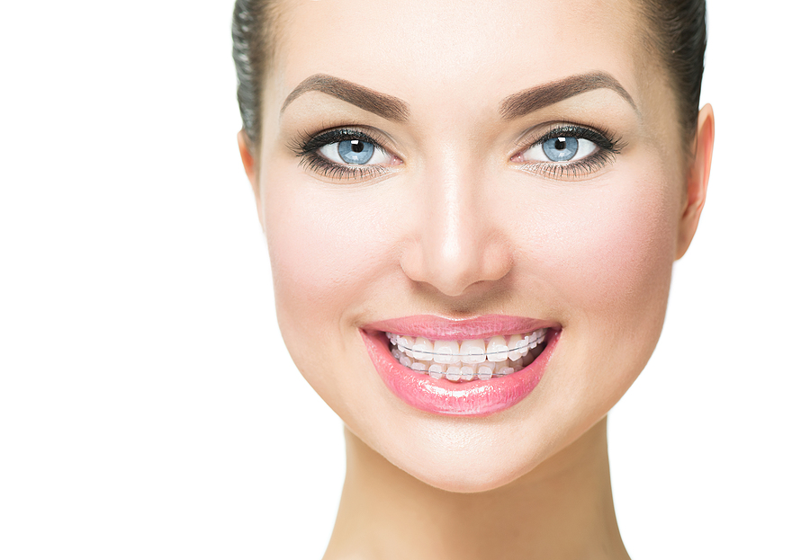 Top Benefits of Choosing Invisalign Over Traditional Braces